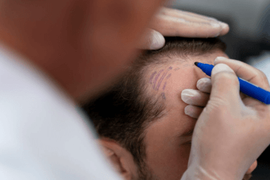 Hair Transplant